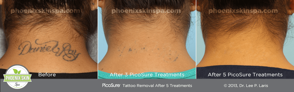 PicoSure Tattoo Removal – Phoenix Skin Spa