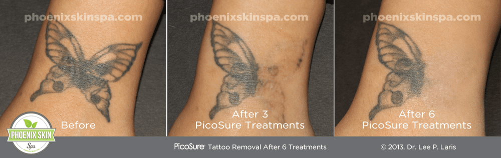 PicoSure Tattoo Removal – Phoenix Skin Spa