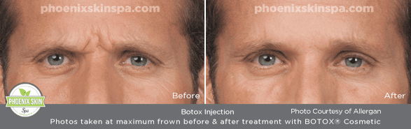 PhoenixSkinSpa_BOTOX_B-A_4