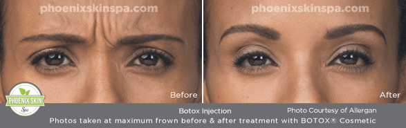 PhoenixSkinSpa_BOTOX_B-A_3